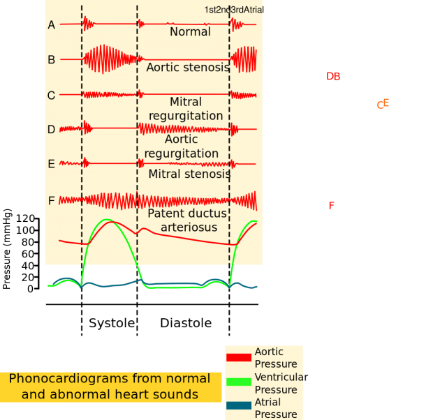 File Phonocardiograms From Normal And Abnormal Heart Sounds With