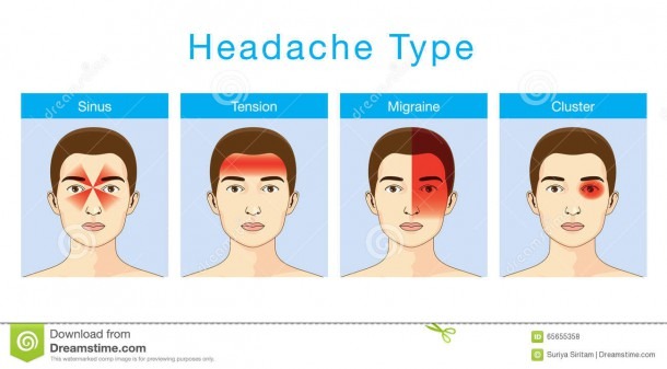 Type Of Headache Stock Vector  Illustration Of Cartoon