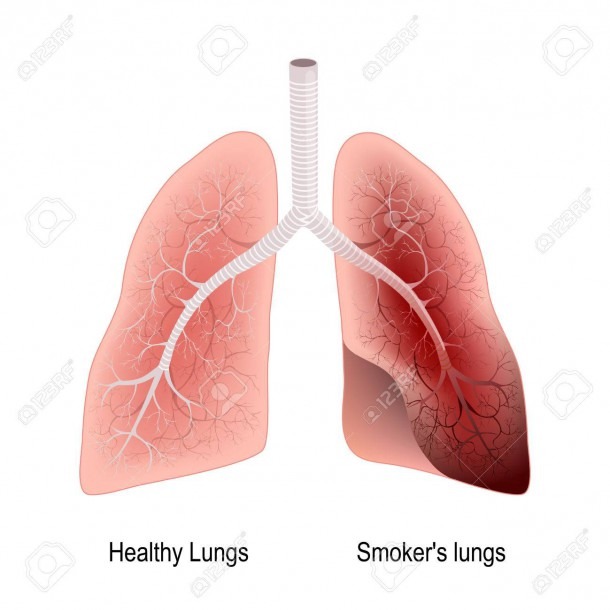 Smoker's Lung And Healthy Lung  Before And After A Lifetime Of