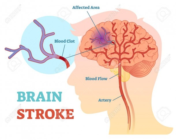 Brain Stroke Anatomical Vector Illustration Diagram, Scheme With
