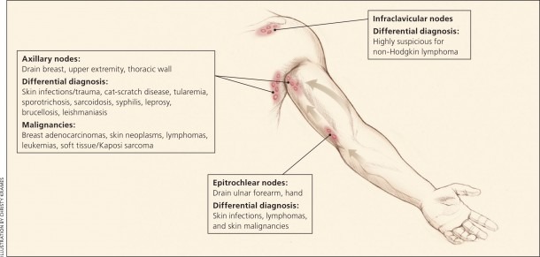 Groin Lymph Nodes Location Diagram