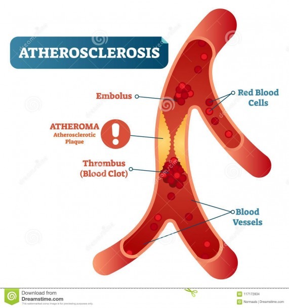 Atherosclerosis Medical Vector Illustration Cross Section Diagram