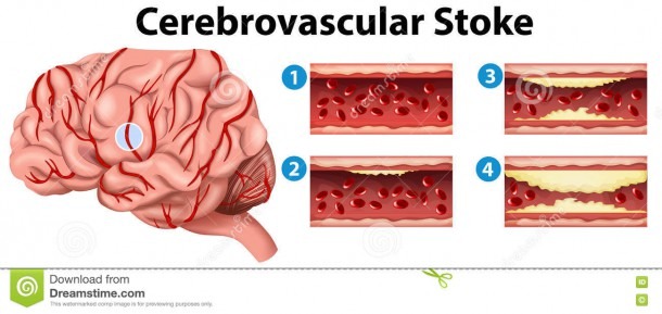 Diagram Showing Stages Of Cerebrovascular Stroke Stock Vector