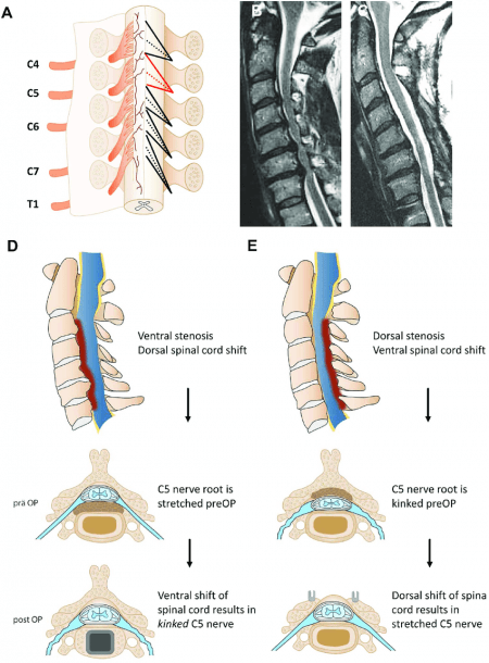 Illustration Of The Cervical Spinal Nerve Roots Exiting The Spinal