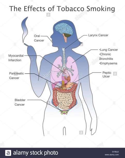 Diagram Of A Smokers Lungs