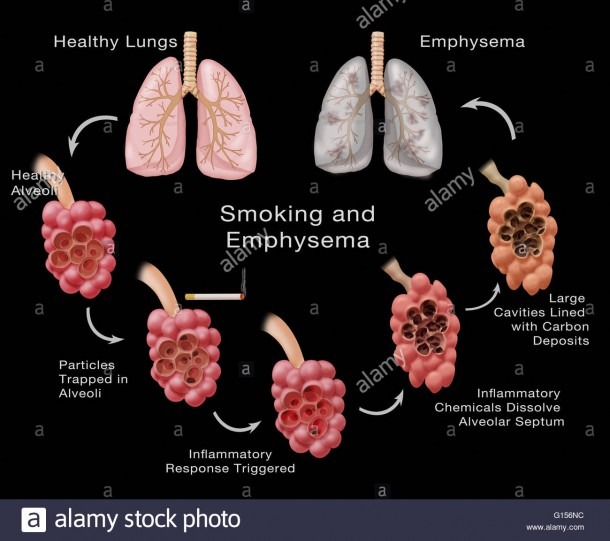 Stages Of Lung Damage Of A Smoker Leading To Emphysema  The Stock