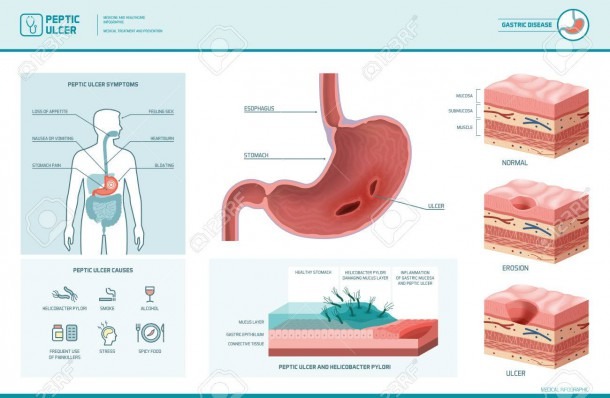 Peptic Ulcer And Helicobacter Pylori Infographic With Symptoms
