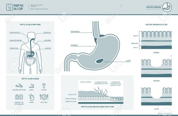 Peptic Ulcer And Helicobacter Pylori Infographic With Symptoms