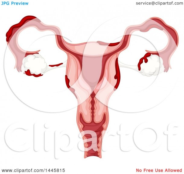 Clipart Of A Medical Diagram Of A Female Ovary With Endometriosis