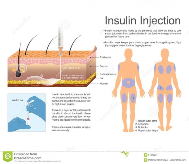 Insulin Injection Sites Diagram