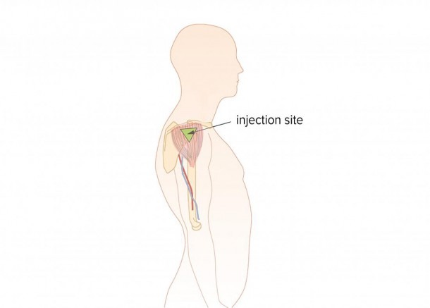 Intramuscular Injection  Locations And Administration