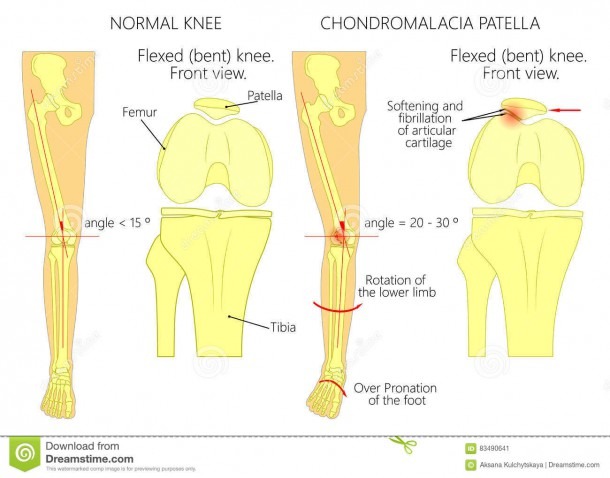 Knee Pain And Chondromalacia Patella Stock Vector