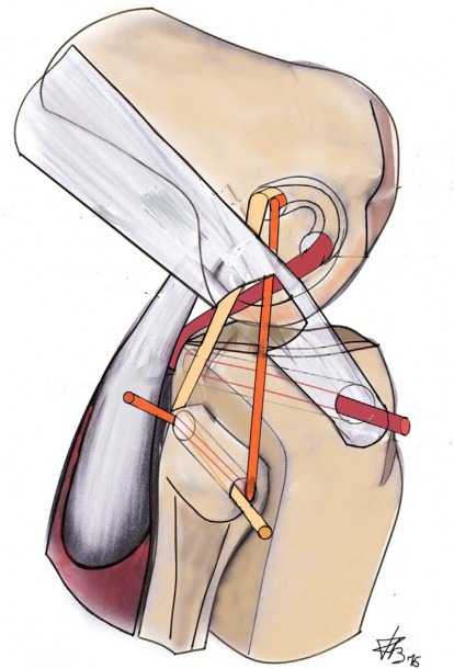 Lateral View Of The Right Knee  Diagram Showing Passage Of The