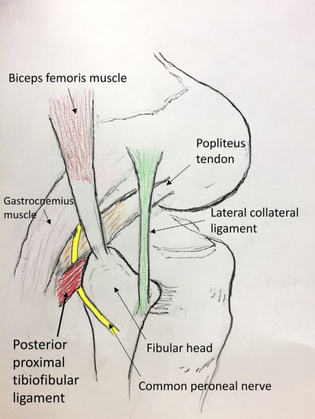 Lateral View Of The Right Knee  Instability Is Caused By Rupture