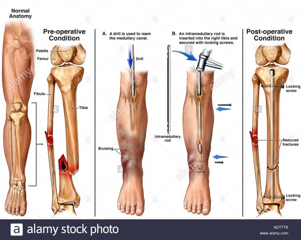Broken Fibula Diagram
