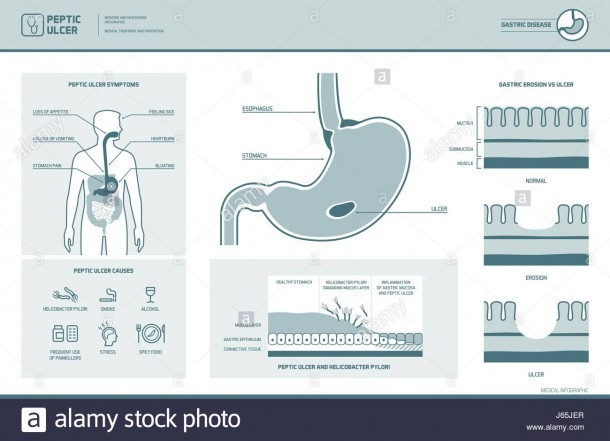 Peptic Ulcer And Helicobacter Pylori Infographic With Symptoms And