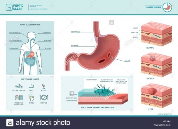 Peptic Ulcer And Helicobacter Pylori Infographic With Symptoms And