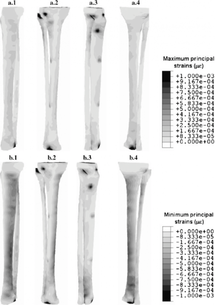Tension (a) And Compression (b) Principal Strains In The Healthy