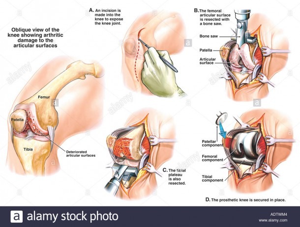 Total Right Knee Replacement Surgery Stock Photo  7710467